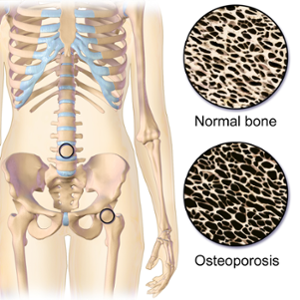 Menopause leads to decreased bone density, which puts women at risk of osteoporosis or bone fractures